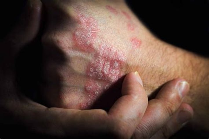 Can psoriasis be related to celiac disease?