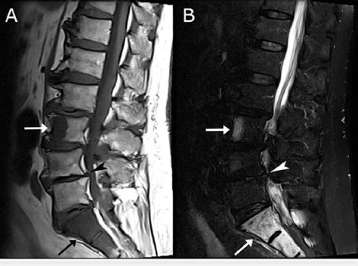 What is a MRI spine lumbar and sacral