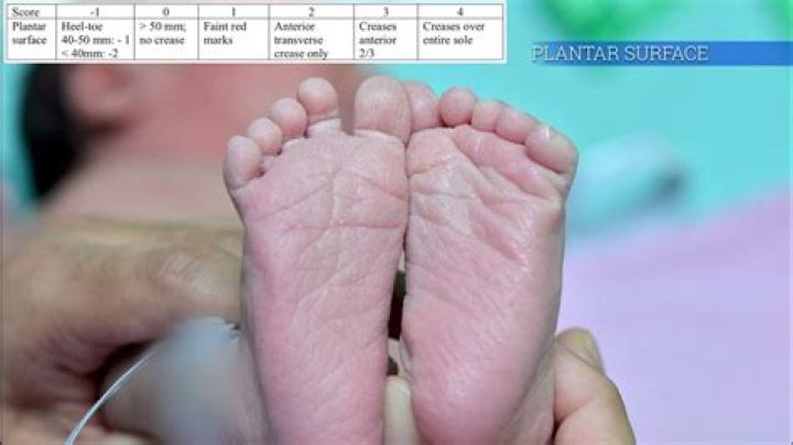 What is Ballard score for newborn