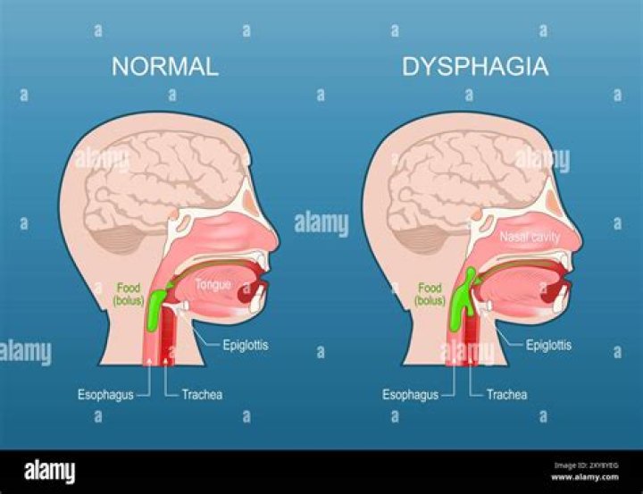 What is Cricopharyngeal dysphagia