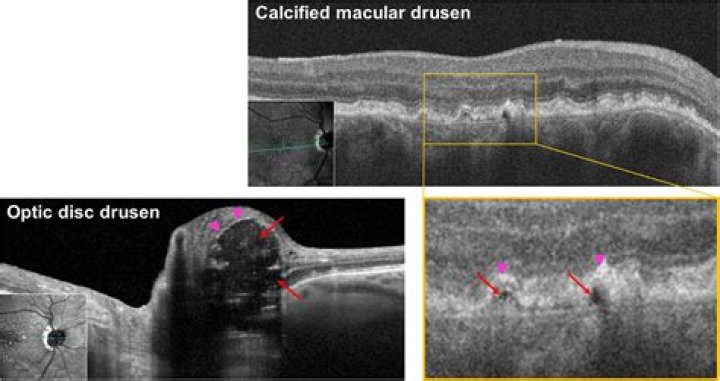 What is peripheral retinal drusen