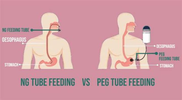 What should pH be for NG tube